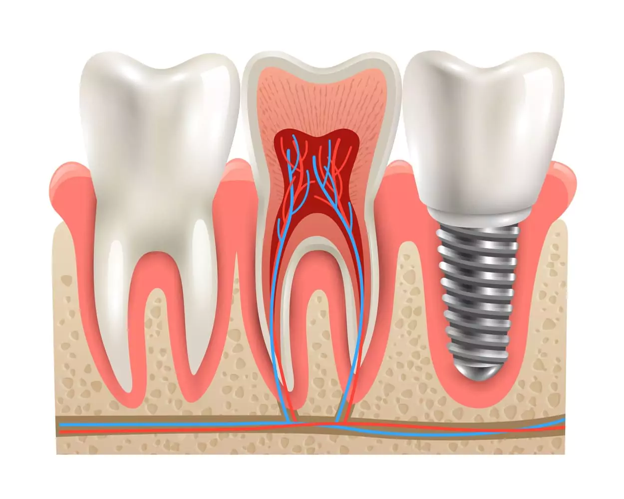 Invisalign