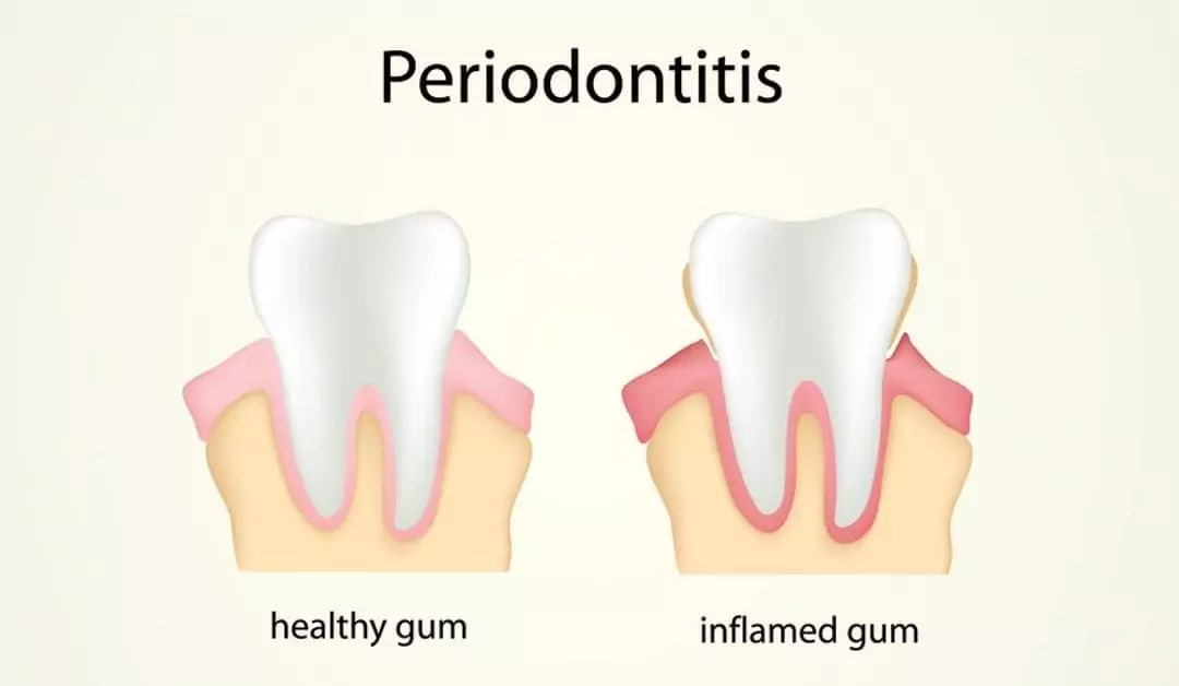 Invisalign